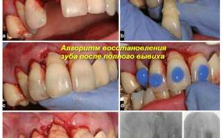 Как вылечить вывих молочного зуба у ребенка
