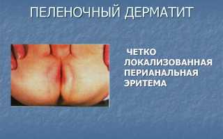 Пелёночный дерматит: помогаем малышу