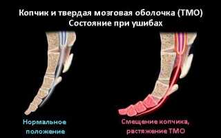 Ушиб копчика при падении: последствия и лечение