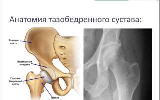 Асептический некроз головки бедренной кости