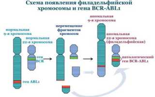 Миелолейкоз
