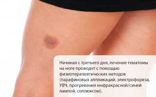 Лечение гематомы на ноге
