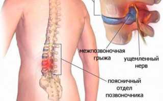Упражнения при грыже поясничного отдела позвоночника