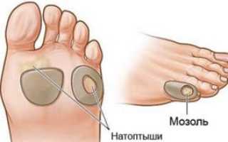 Как избавиться от натоптышей?