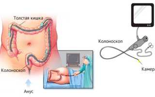 Язвенный колит кишечника