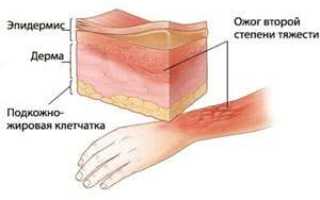 Первая помощь при термических ожогах