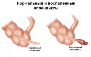 Тесты по теме «острый аппендицит»