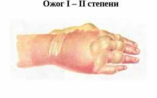 Пузыри и волдыри после ожога