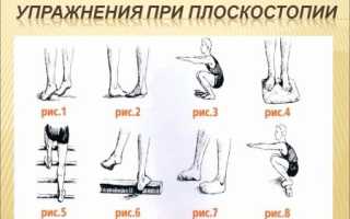 Лечение плоскостопия, последствия и профилактика