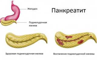 Язва желудка и двенадцатиперстной кишки — симптомы
