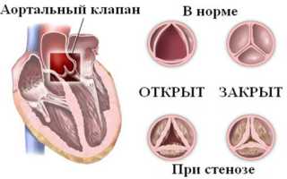 Приобретённый порок сердца — симптомы и лечение