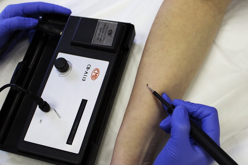 Электрокоагуляция сосудов