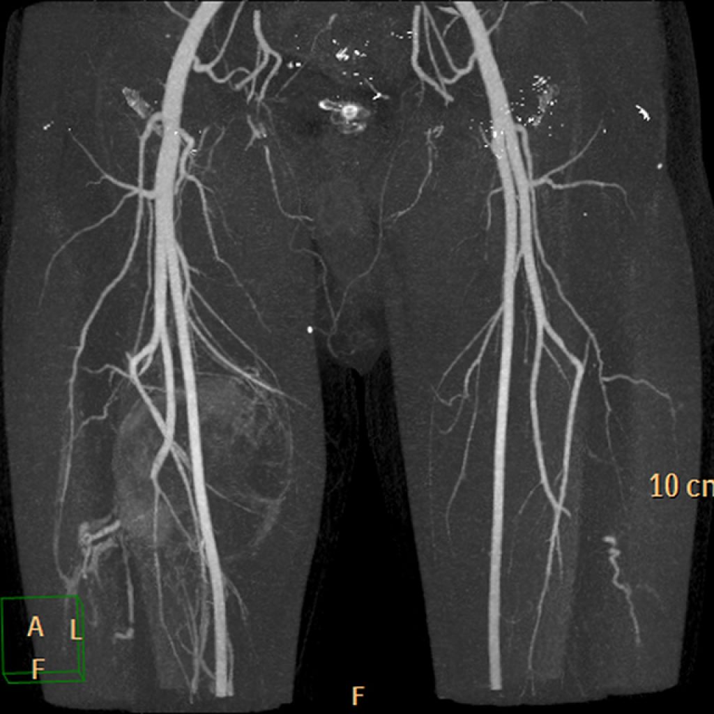 Ангиография