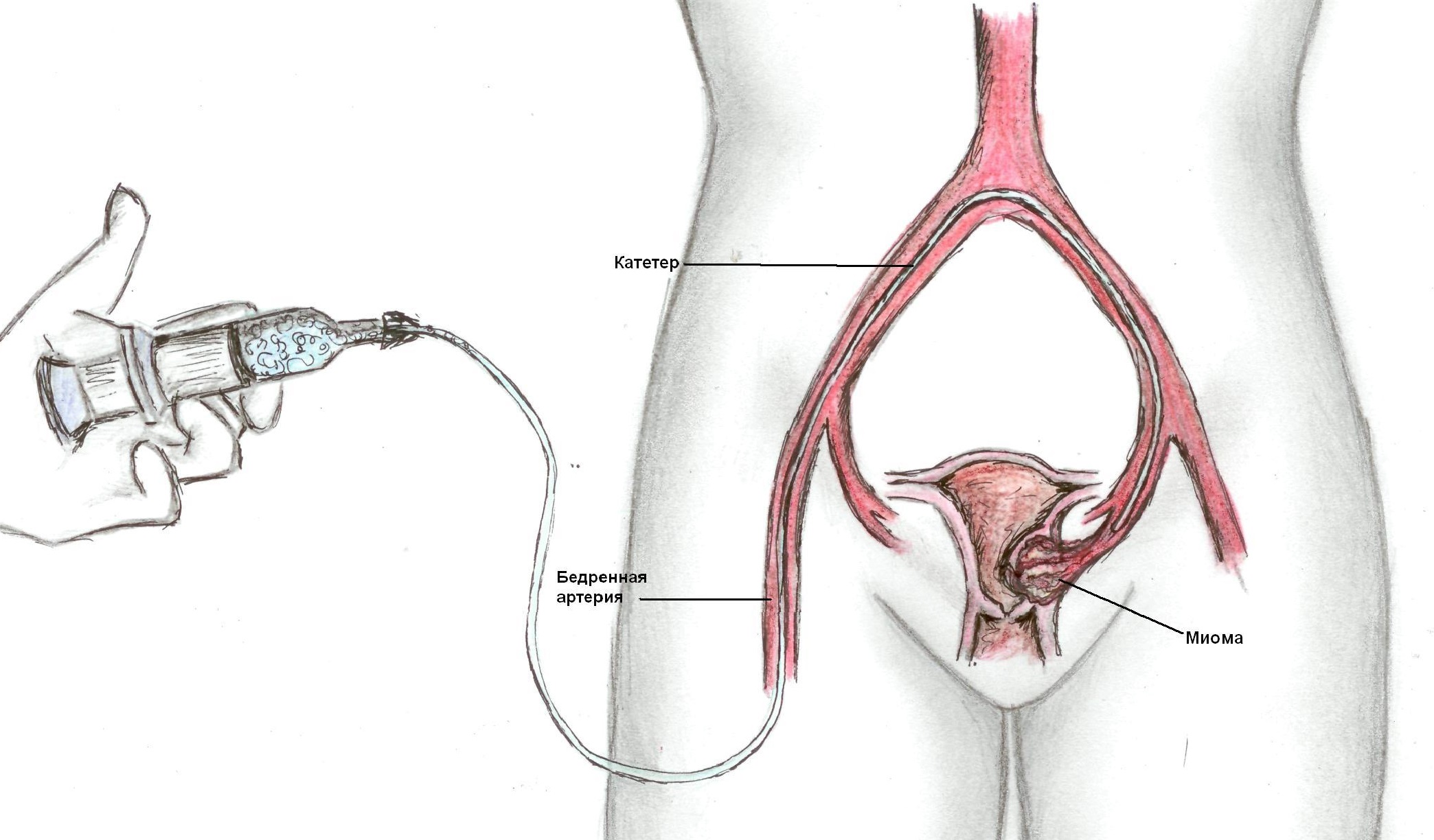 Эмболизация маточных артерий