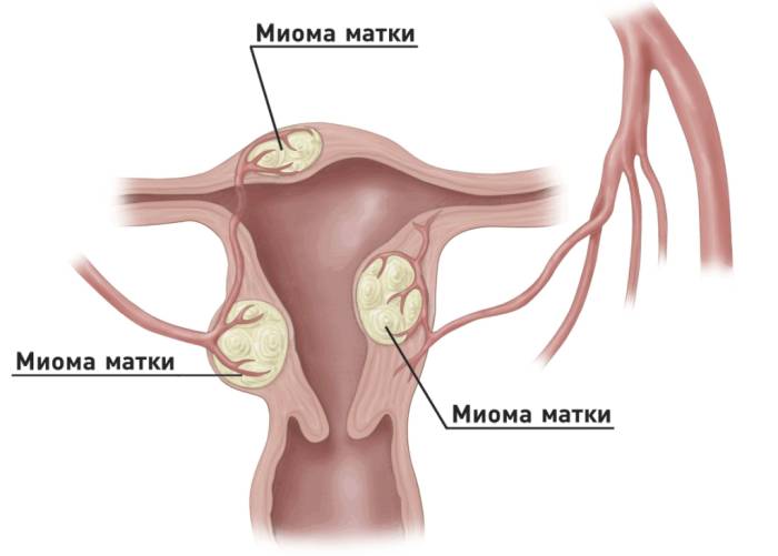 Эмболизация маточных артерий