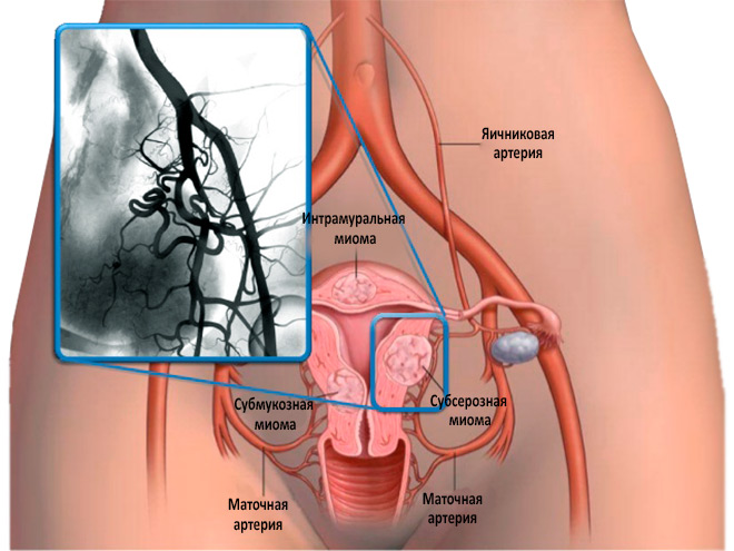 Эмболизация маточных артерий
