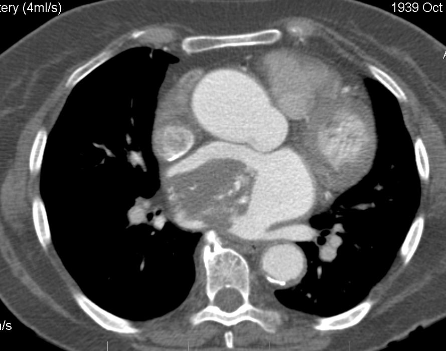 миксома сердца