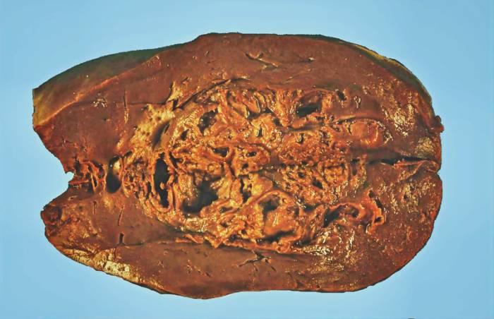 Печеночный абсцесс