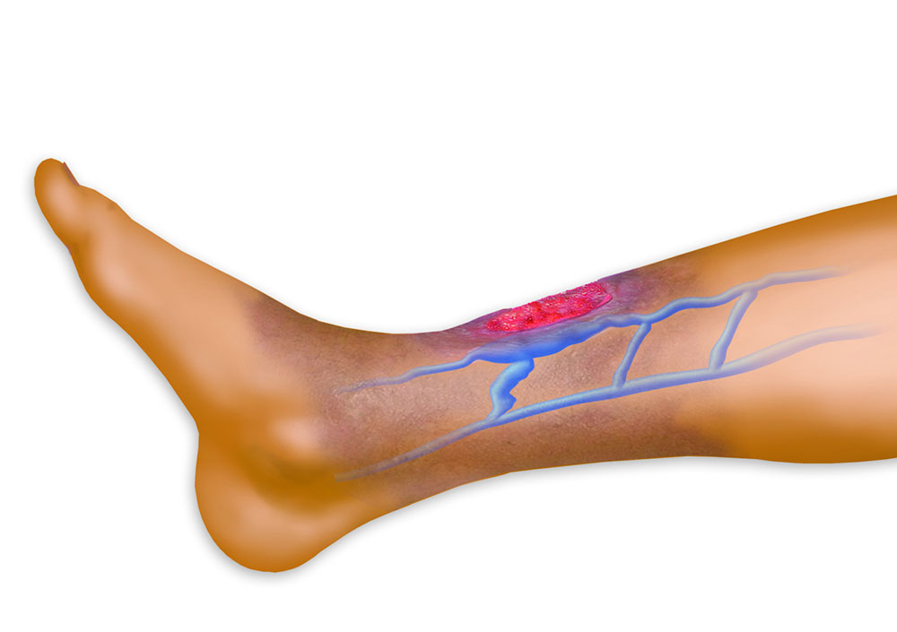 Венозные язвы