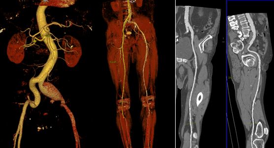 Виды инструментальной ангиографии