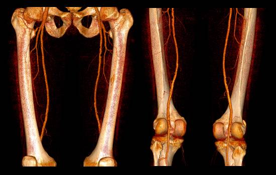побочные эффекты ангиографии сосудов нижних конечностей