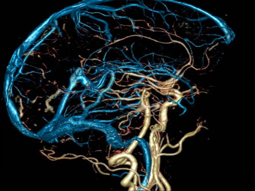 ангиография