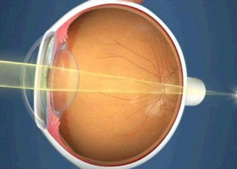 Ангиопатия сетчатки глаза причины