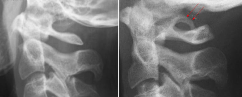 Аномалия Киммерли: симптомы