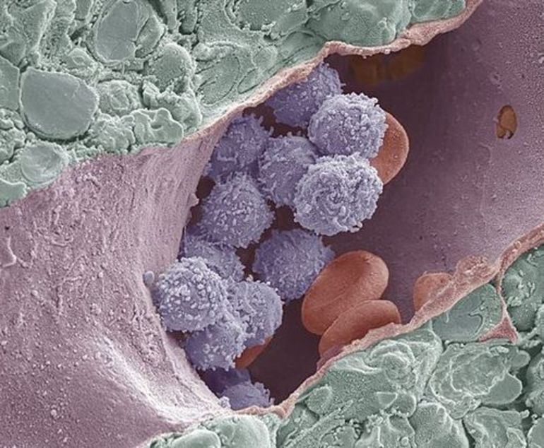 Апластический криз