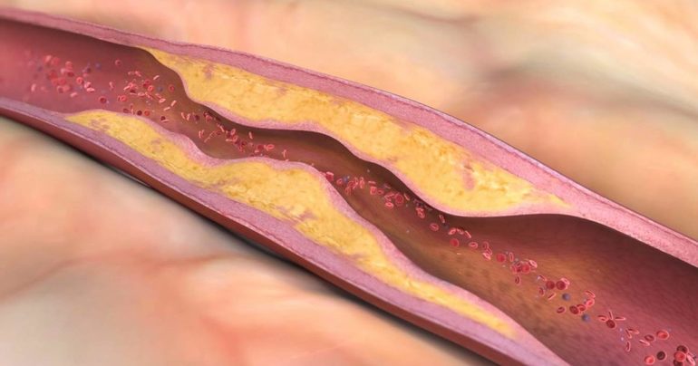 Атеросклеротический процесс развивается на стенках брюшной артерии