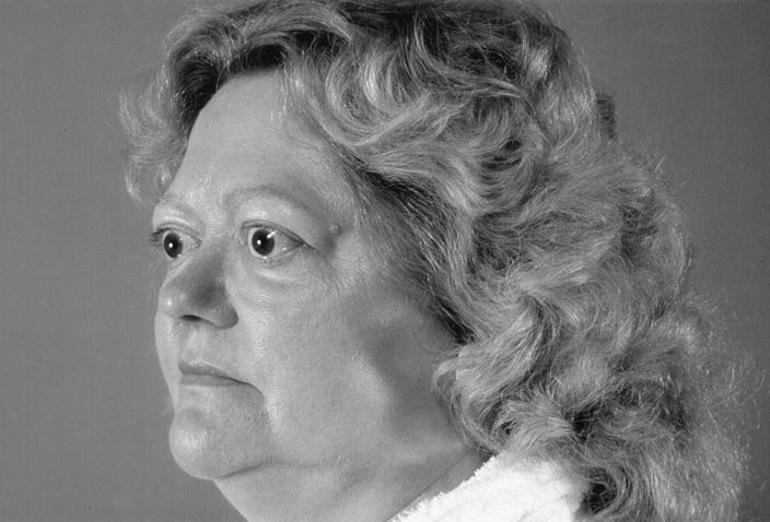 Базедова болезнь