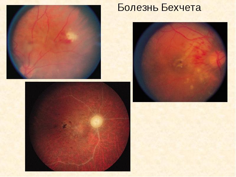 болезнь бехчета