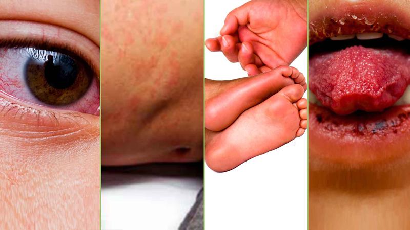 синдром кавасаки