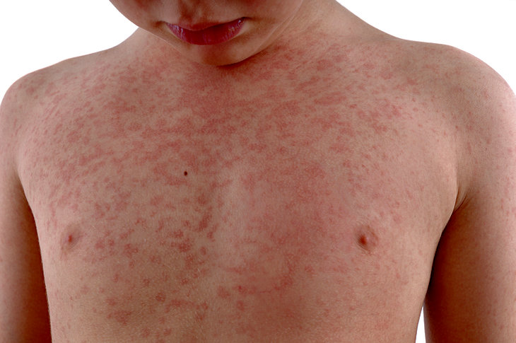 синдром кавасаки