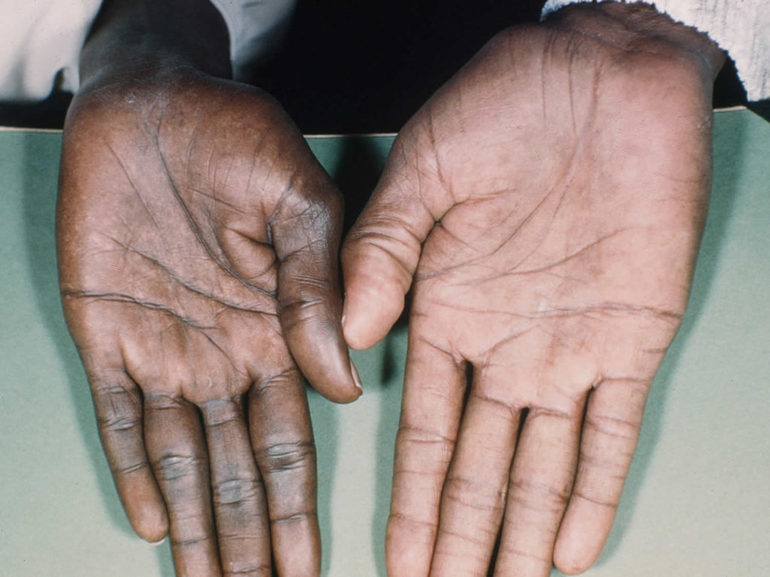 Болезнь Аддисона