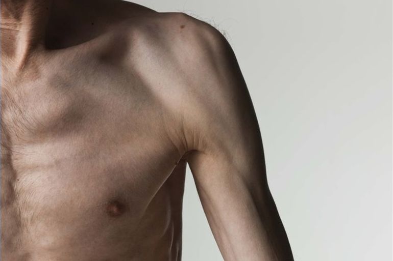 Болезнь Миопатия.