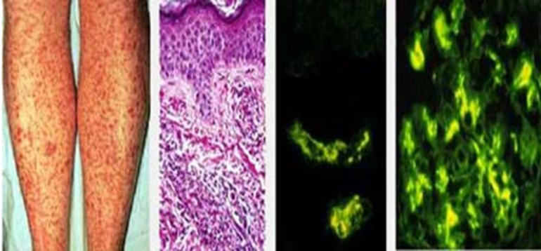 Болезнь вегенера
