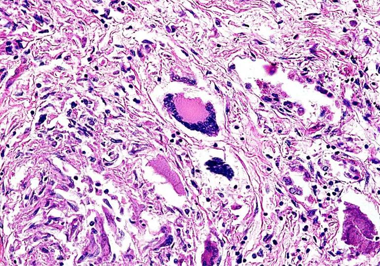 Болезнь вегенера как передается