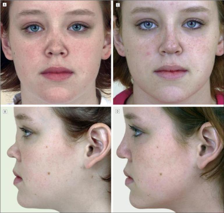 болезнь вегенера симптомы