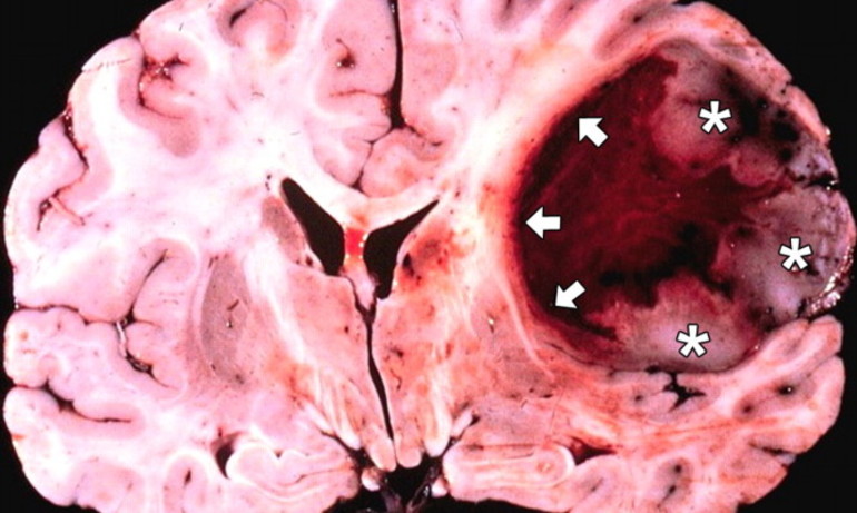Болезни, которые приводят к серьезным последствиям и летальному исходу
