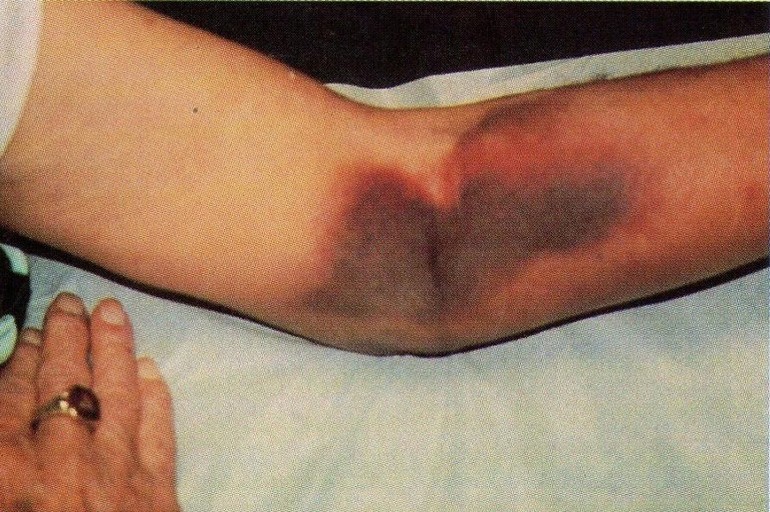 Болезни Виллебранда прогноз для пациента