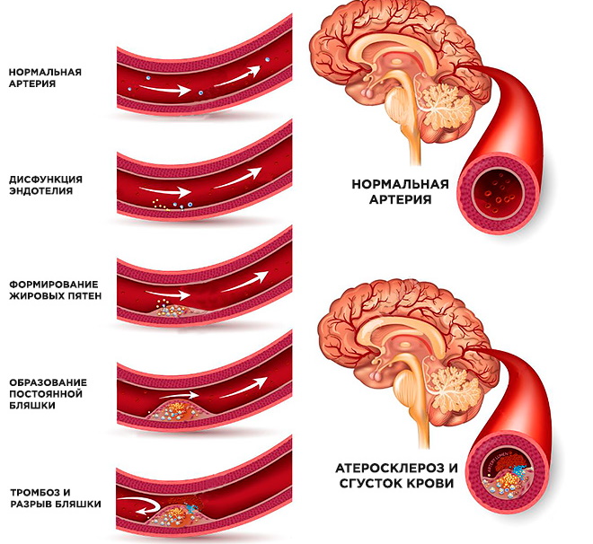 cerebral-nyy-aterosklero