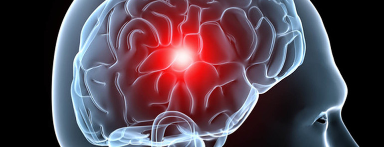 Чаще всего человек умирает из-за кровоизлияния в мозг