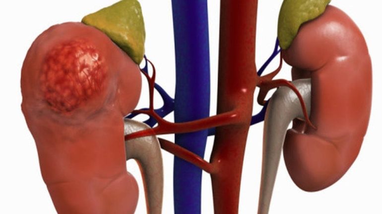 Давление может повыситься при болезнях почек,