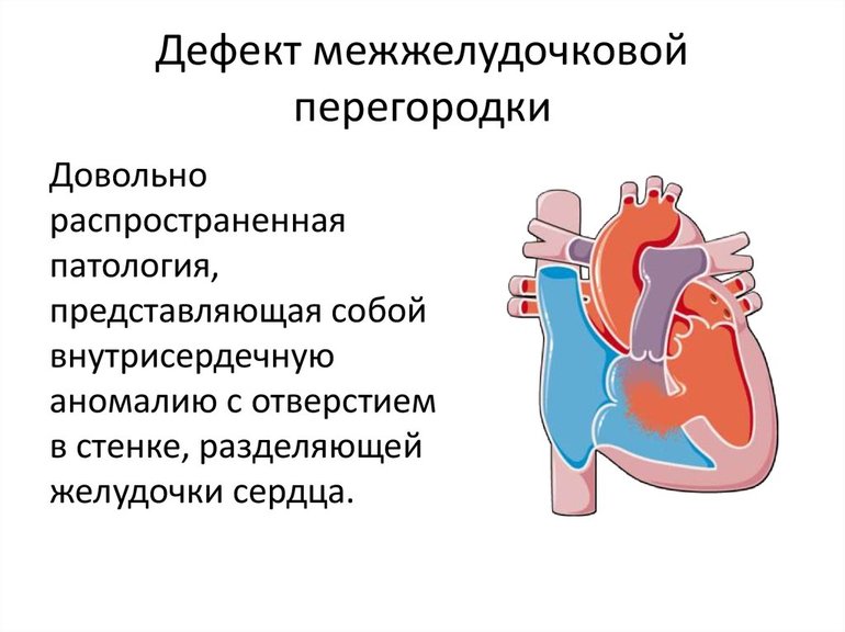 Дефект межжелудочковой перегородки