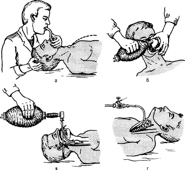 Действия реаниматологов