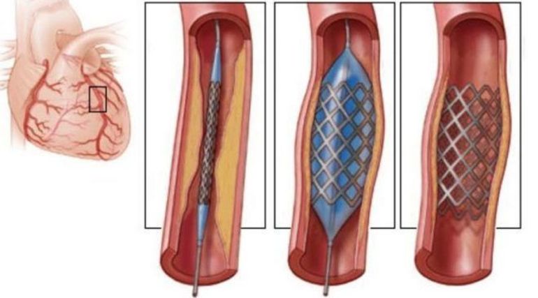 Диффузный кардиосклероз