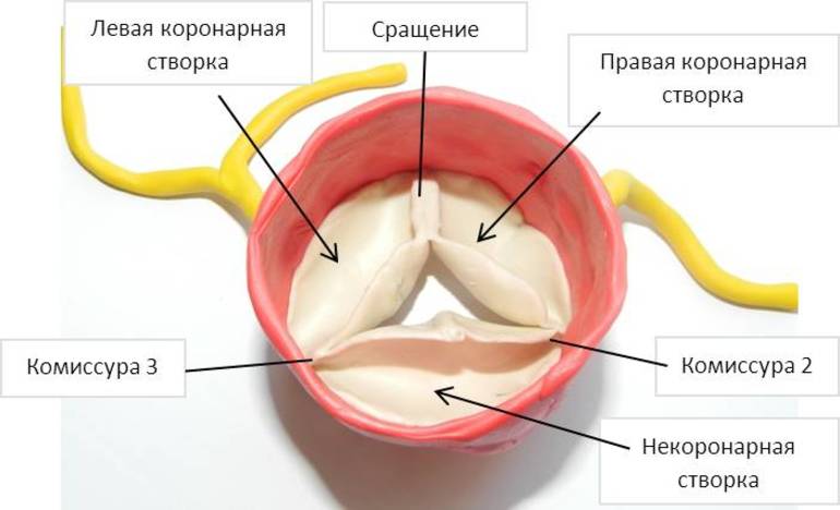 Двустворчатый аортальный клапан