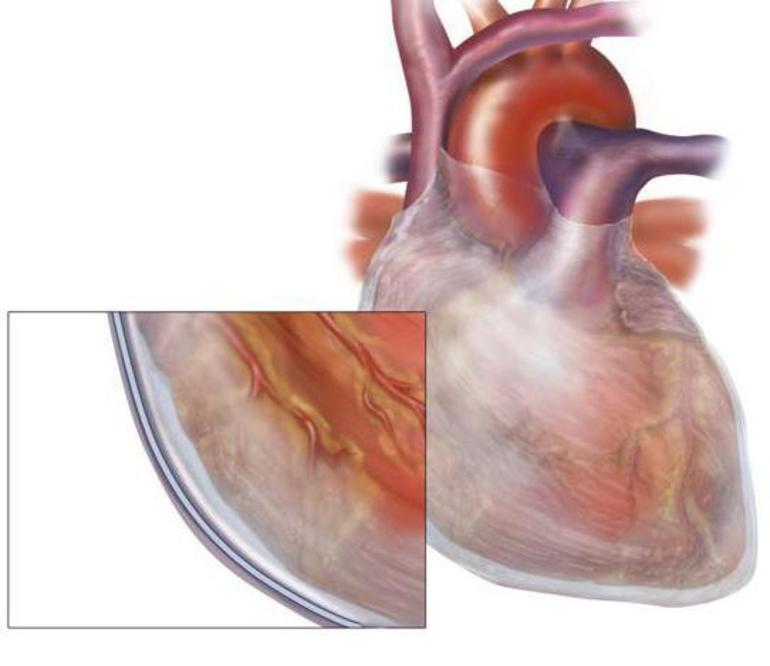 Экссудативный перикардит