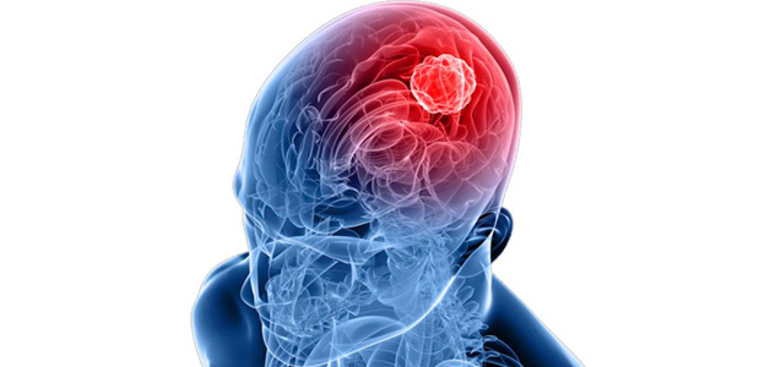 Энцефалит головного мозга